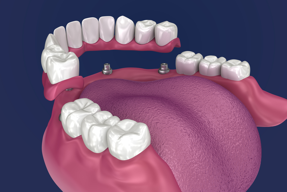 Full Mouth All on 4 Implants